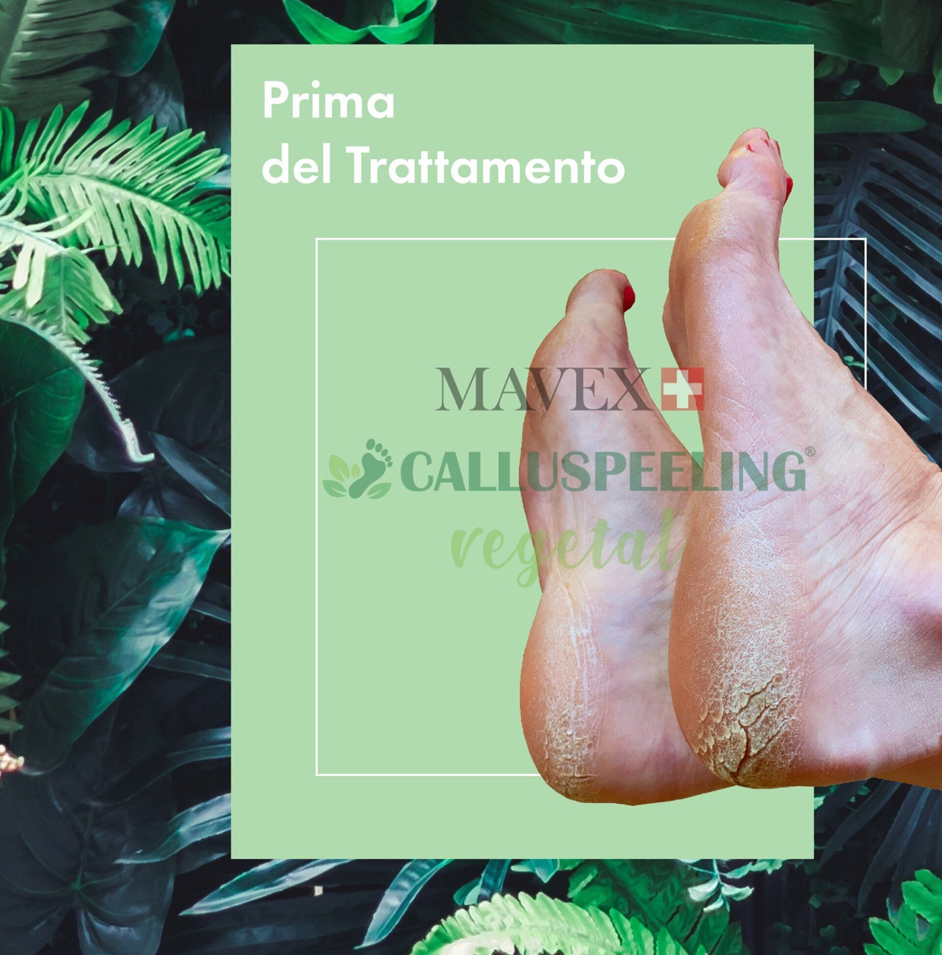 Calluspeeling vegetal Mavex - prima e dopo